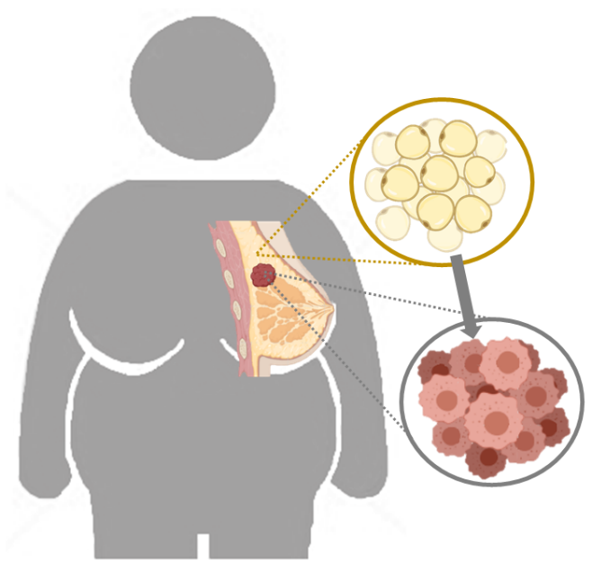 R?le des cellules myopithliales dans le dveloppement du cancer du sein